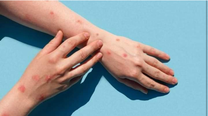 ВОНРЕДНА ВЕСТ: Прв сомнителен случај на мајмунски сипаници во Македонија